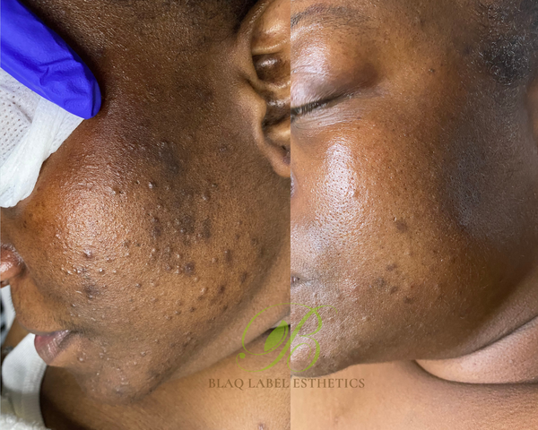 Acne Facial: Why You Need Professional Treatment